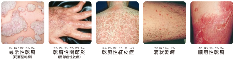 type-of-psoriasis